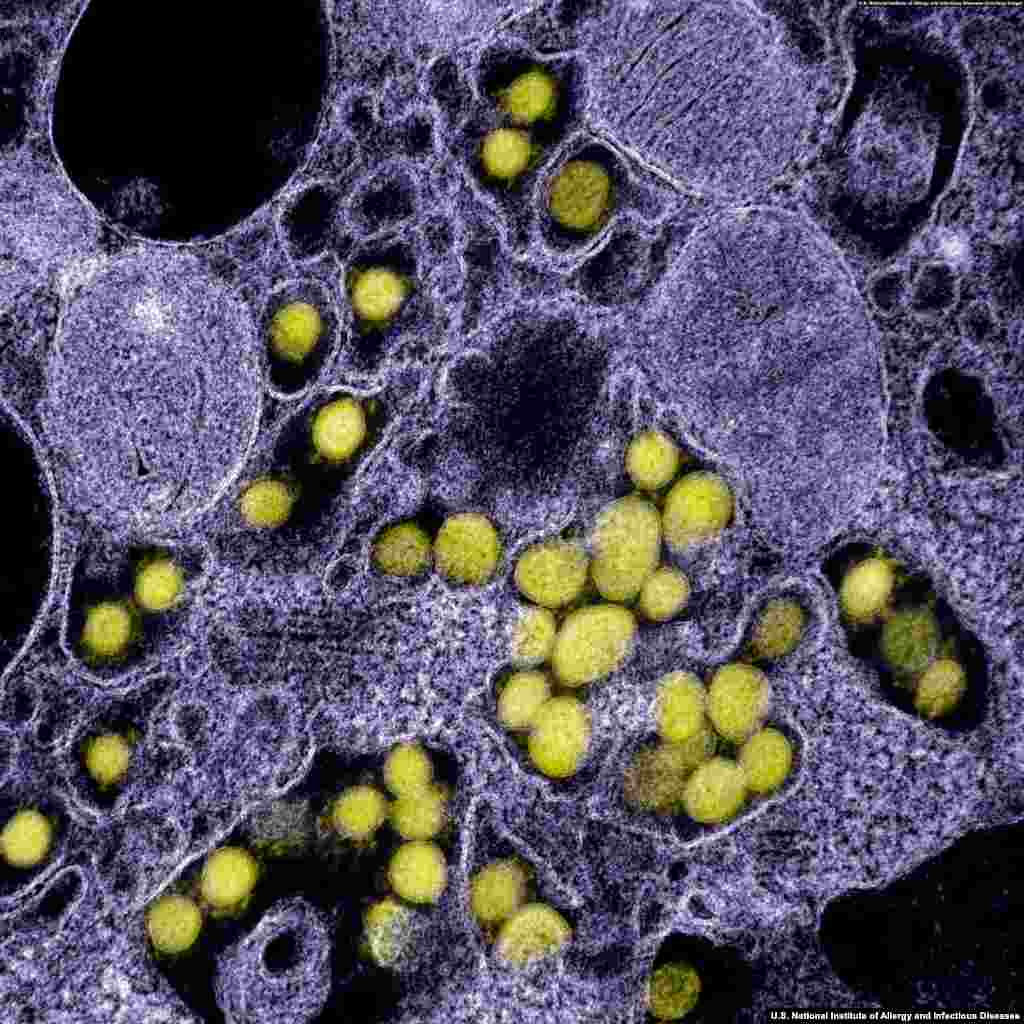 SARS-CoV-2 virions in a human cell. Medical experts advise regular handwashing and not touching one's face are the most important things to reduce the risk of contracting the virus. (Courtesy: U.S. National Institute of Allergy and Infectious Diseases)
