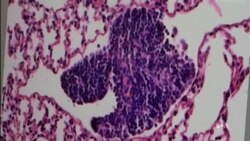 VOA英语视频: 科学家发现阻止癌细胞扩散的奥秘 VOA英语视频: 科学家发现阻止癌细胞扩散的奥秘