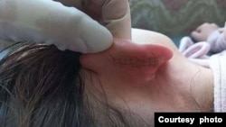 汉语教师梁玉霞扯裂蒙古族九岁女学生的耳朵根,导致严重伤害 (南蒙古人权信息中心提供)