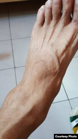 张桂林脚被砸受伤(张桂林提供)