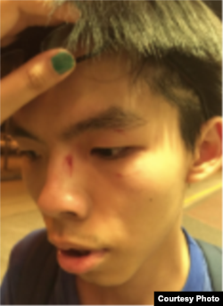 黄之锋遇袭之后受伤(黄之锋脸书图片)