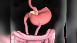 Phẫu thuật bắc cầu dạ dày đẩy lui bệnh tiểu đường loại 2 Phẫu thuật bắc cầu dạ dày đẩy lui bệnh tiểu đường loại 2