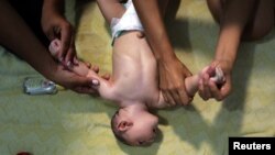 Virut Zika được cho là có liên hệ đến 4.000 ca bị đầu nhỏ ở Brazil, một bệnh trạng dẫn tới đầu nhỏ và teo não nơi trẻ sơ sinh.