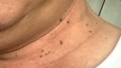 Hỏi đáp Y học: Thịt dư da (Skin tags) Hỏi đáp Y học: Thịt dư da (Skin tags)
