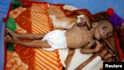 一岁大的法提玛·哈桑因严重营养不良躺在也门荷台达市医疗中心的病床上。(2017年12月20日)