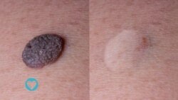 Moles da Skin Tags wasu lalurori na fata masu kama da tsiro wadanda a hankali suke girma, ba sa lahani sai idan sun fara kaikayi ko zafi