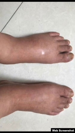 江天勇浮肿的双脚 (网络截图)