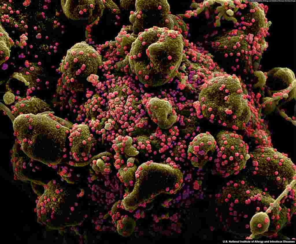 Detail of a human cell heavily infected by SARS-CoV-2. Once expelled from a patient's body, the virus is believed to survive for up to several days on some surfaces. (Courtesy: U.S. National Institute of Allergy and Infectious Diseases)