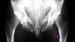 အရိုးပွရောဂါကို အမျိုးသမီးတွေ ဘယ်လိုကာကွယ်မလဲ အရိုးပွရောဂါကို အမျိုးသမီးတွေ ဘယ်လိုကာကွယ်မလဲ